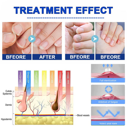 **NordiCure™ Laser - Restore the Health of Your Nails with Scandinavian Precision 🌿✨